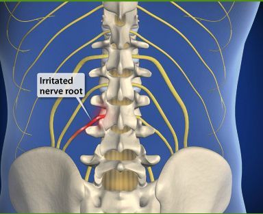 http://www.spinalsurgeon.com/wp-content/uploads/Sciatica-image-1.jpg